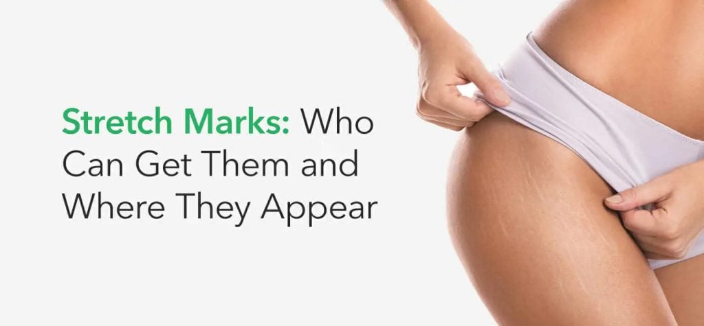 A woman examining her stretch marks on her upper thigh next to the words stretch marks who can get them
