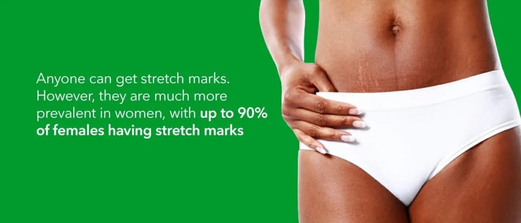 Smooth and Reconstruct Your Skin with Ask Cares Stretch Marks Treatment