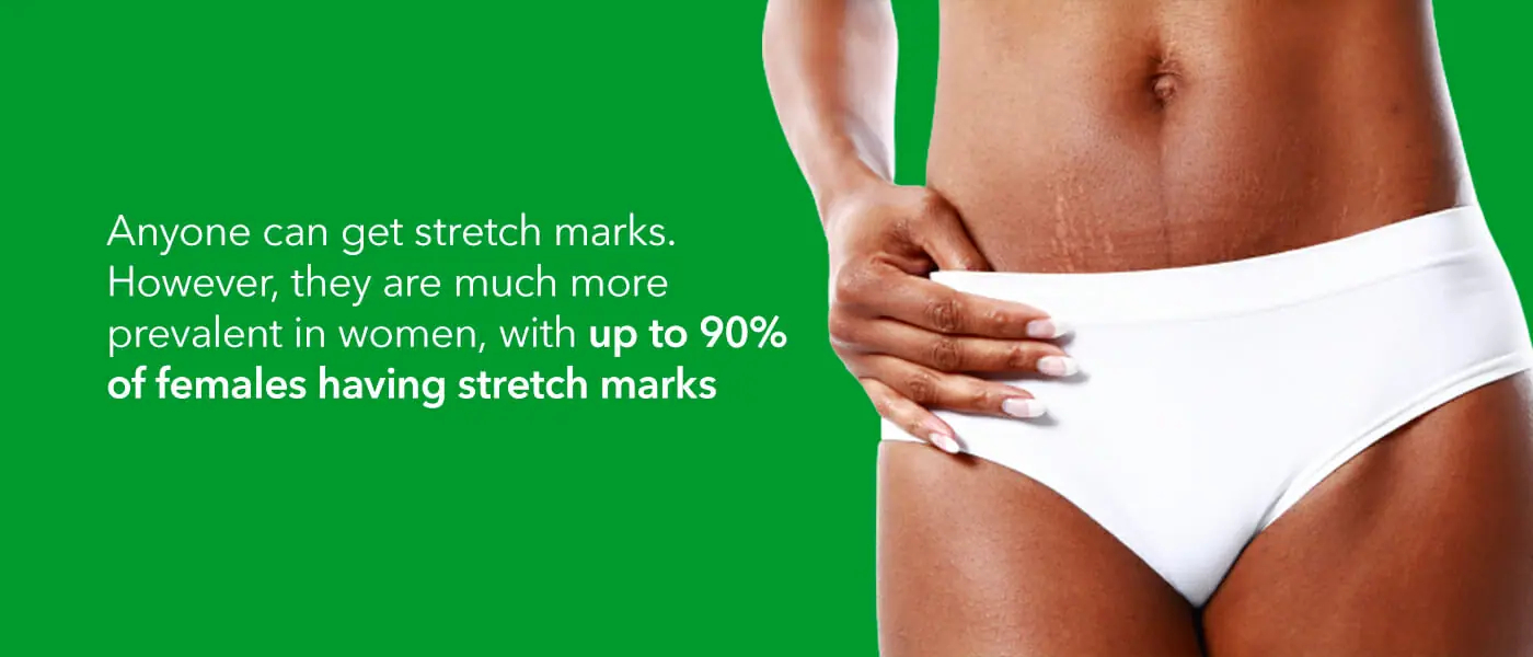 How To Remove Stretch Marks On Arms Synergy Wellness