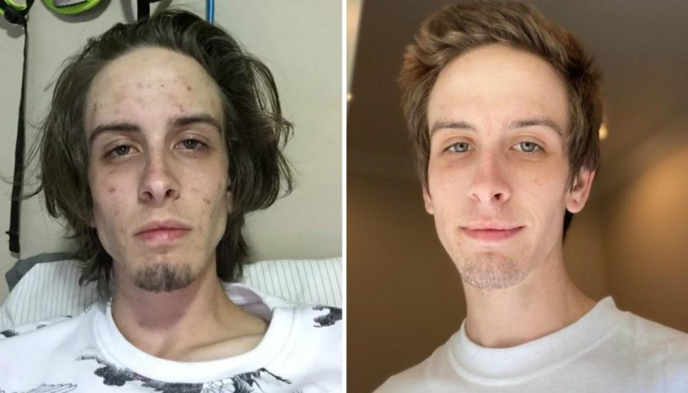 a before and after photo of a young man who had addiction treatment