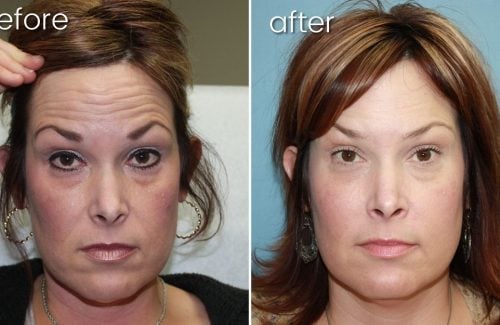 Before & After Wrinkle Treatment | Synergy Wellness Center | Wrinkle Treatment Services | Bakersfield CA