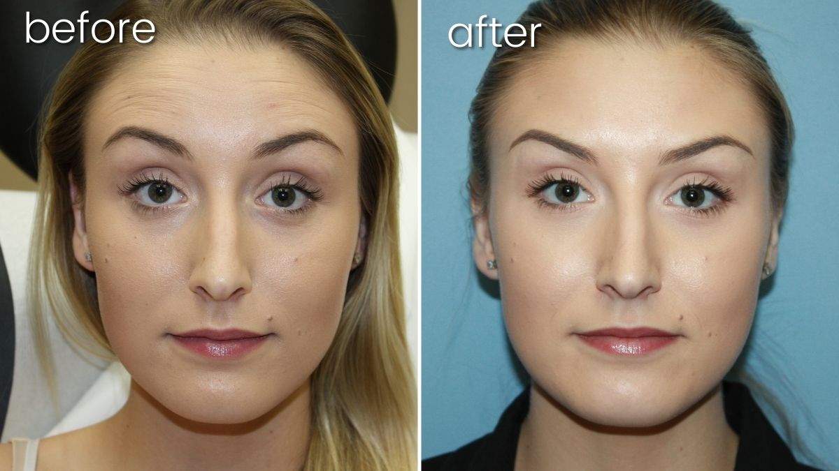 Before & After Botox on Young Woman's Forehead | Botox - Bakersfield CA