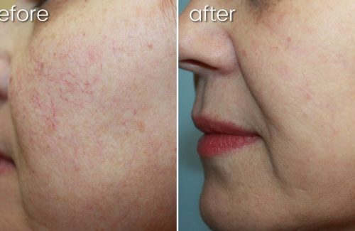 a before and after photo of a blood vessels on a woman's face after lumecca