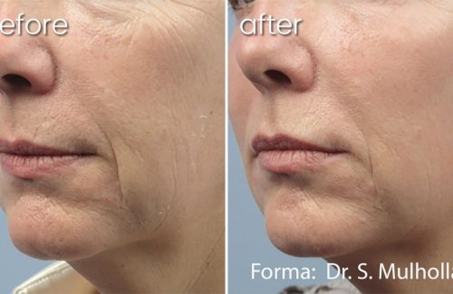 Before and After Anti-Aging Treatment around Woman's Mouth| Forma Skin Treatment - Bakersfield CA