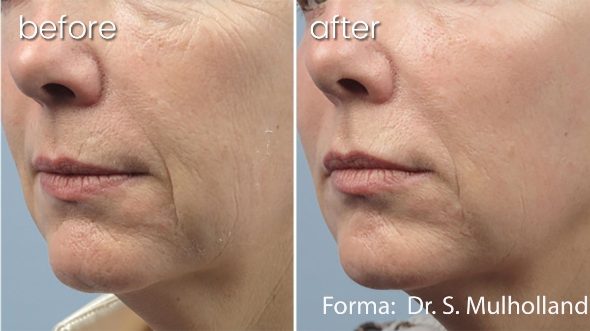 Before and After Anti-Aging Treatment around Woman's Mouth| Forma Skin Treatment - Bakersfield CA