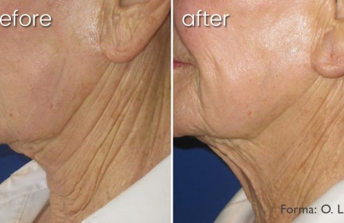 Before & After Forma Skin Treatment on Woman's Face | Anti-Aging Treatment - Bakersfield CA