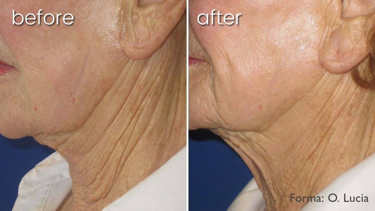 Before & After Forma Skin Treatment on Woman's Face | Anti-Aging Treatment - Bakersfield CA