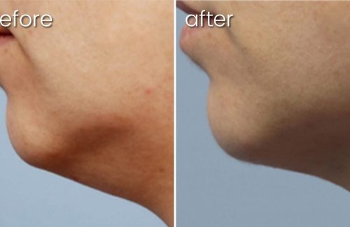 a before and after photo of a woman 's face showing the results of forma services