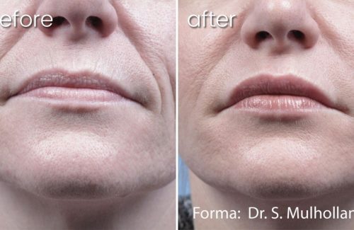 Before & After Forma Treatment on Woman's Face | Skin Treatment - Bakersfield CA