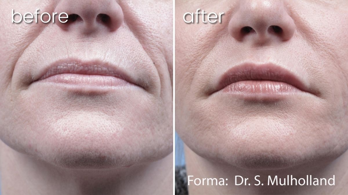 Before & After Forma Treatment on Woman's Face | Skin Treatment - Bakersfield CA