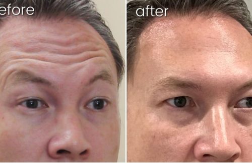 Before and after comparison of forehead botox