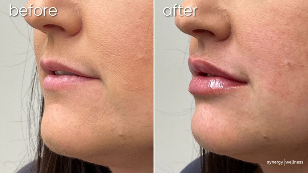 Dermal Filler on Young Woman's Lips Before & After | Lip Fillers - Bakersfield CA