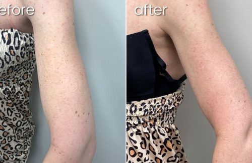 Before & After Lumecca Skin Treatment on Woman's Arm | Dark Spot Removal - Bakersfield CA