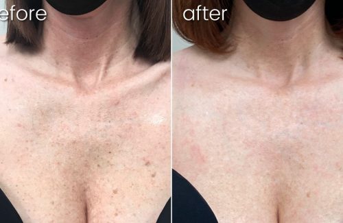 a before and after photo of a woman 's chest after using lumecca