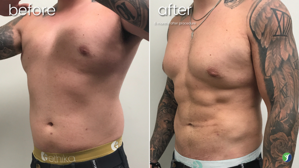 VaserLipo Before and After on Male's Abdomen | Male Liposuction - Bakersfield CA