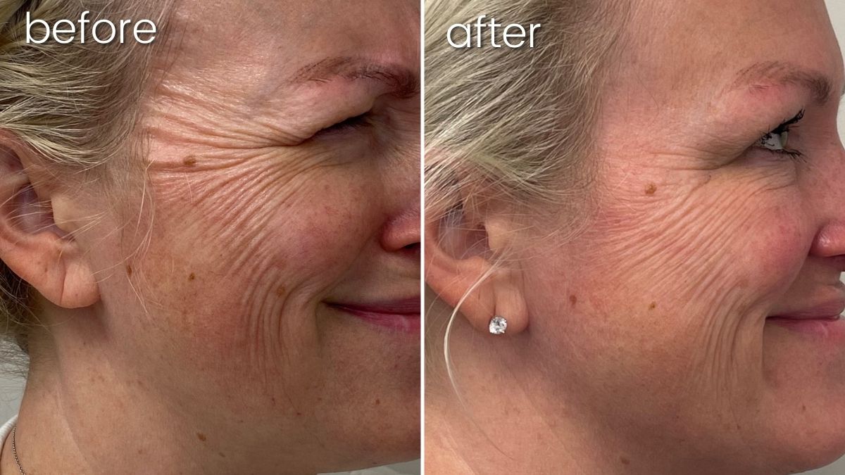 Before & After Botox | Synergy Wellness Center | Wrinkle Treatment | Bakersfield CA