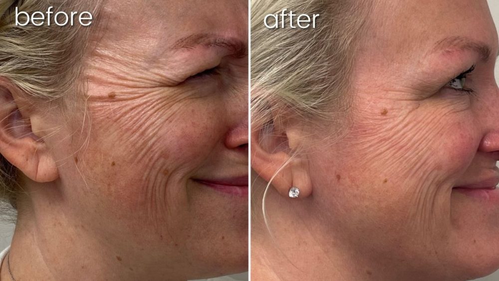 Before and after comparison of improved crows feet wrinkles