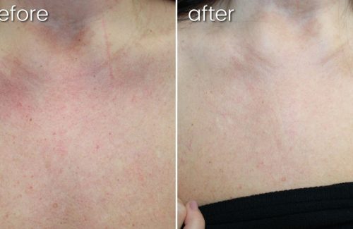 Before & After Lumecca on Women's Chest for Blood Vessels | Lumecca - Bakersfield CA