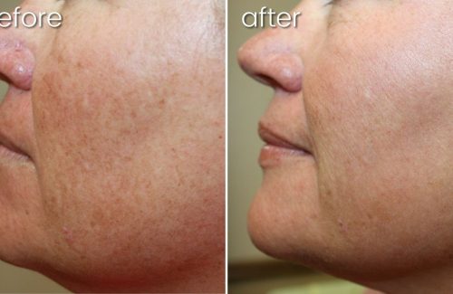 Before & After Lumecca on Woman's Face | Synergy Wellness Center | Dark Spot Removal | Bakersfield CA