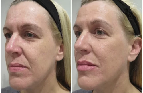 Before & After Dermal Filler on Woman's Face | Lip Fillers - Bakersfield CA