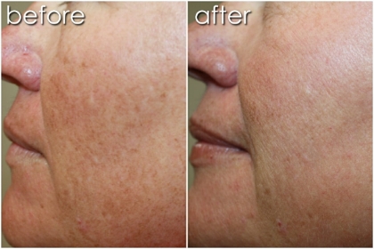 Before & After Fractora Treatment on Woman's Face | Anti- Aging Skin Treatment - Bakersfield CA