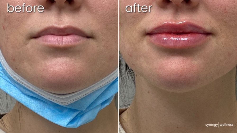 Before & After Lip FIllers on Young Woman | Lip Fillers - Bakersfield CA