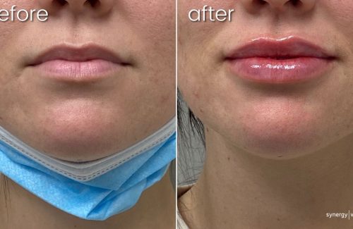 Before & After Lip FIllers on Young Woman | Lip Fillers - Bakersfield CA