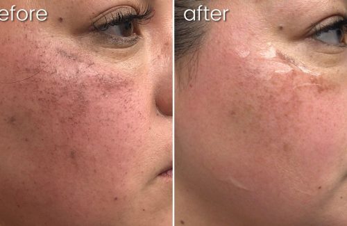 Before & After Lumecca on Woman's Face | Dark Spot Removal - Bakersfield CA