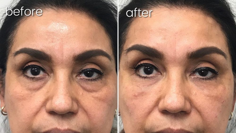 Before & After Undereye Facial Filler on Woman | Facial Fillers - Bakersfield CA