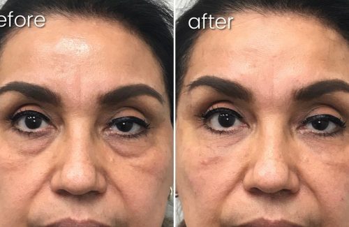 Before & After Undereye Facial Filler on Woman | Facial Fillers - Bakersfield CA