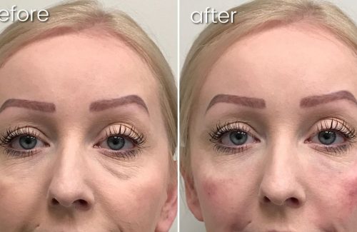 Before and After Undereye Filler on Woman | Facial Fillers - Bakersfield CA