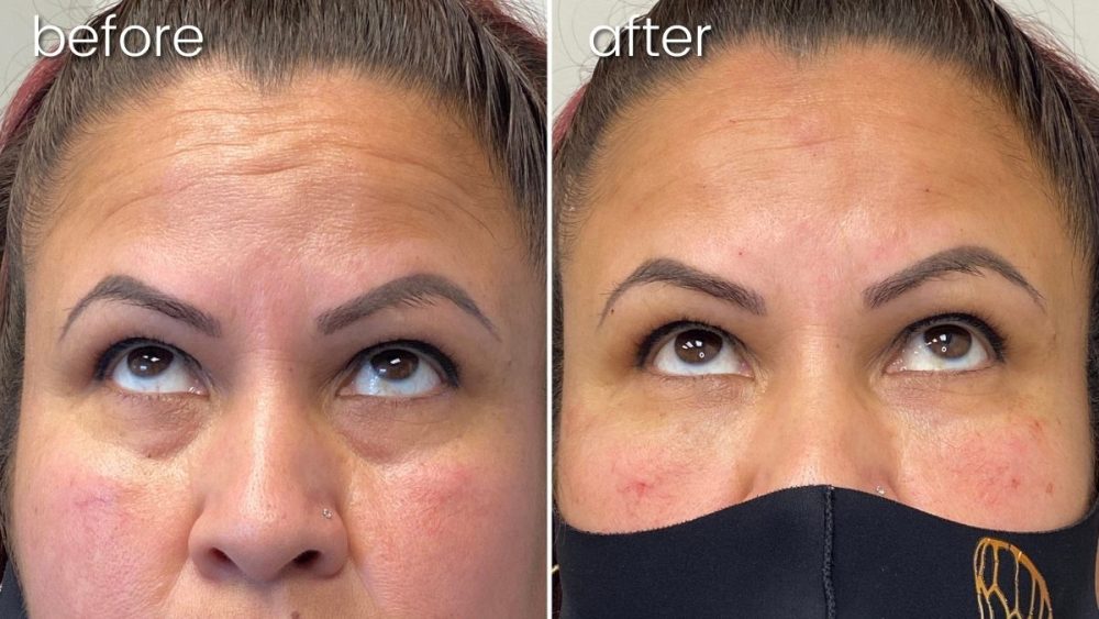 Before & After Undereye FIller on Woman's Face | Facial Fillers - Bakersfield CA