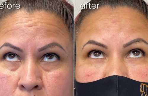 Before & After Undereye FIller on Woman's Face | Facial Fillers - Bakersfield CA