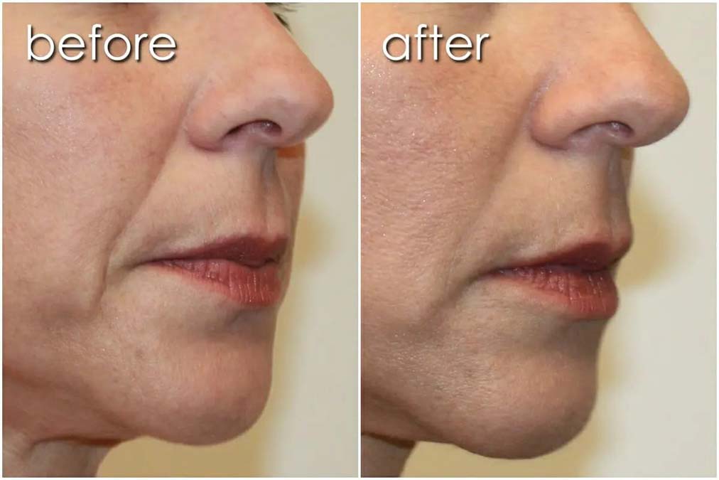 Before & After Skin Treatment on Woman's Face | Skin Treatment - Bakersfield CA