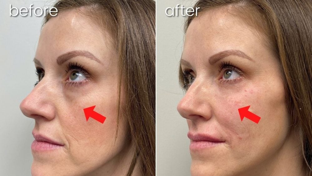 Before & After Mini Fat Transfer to Under Eye Woman's Face | Skiin Treatment - Bakersfield CA
