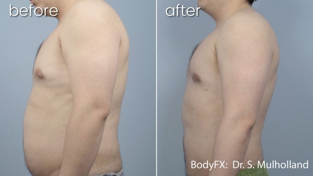 Before & After Body Fx on Man's Mid Section | Body FX - Bakersfield CA