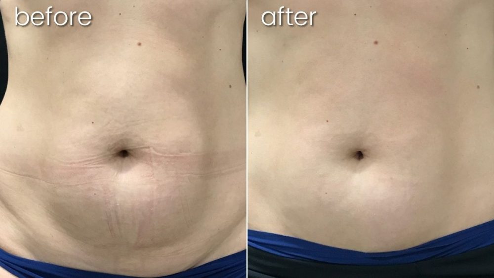 a before and after photo of a woman 's stomach after a procedure