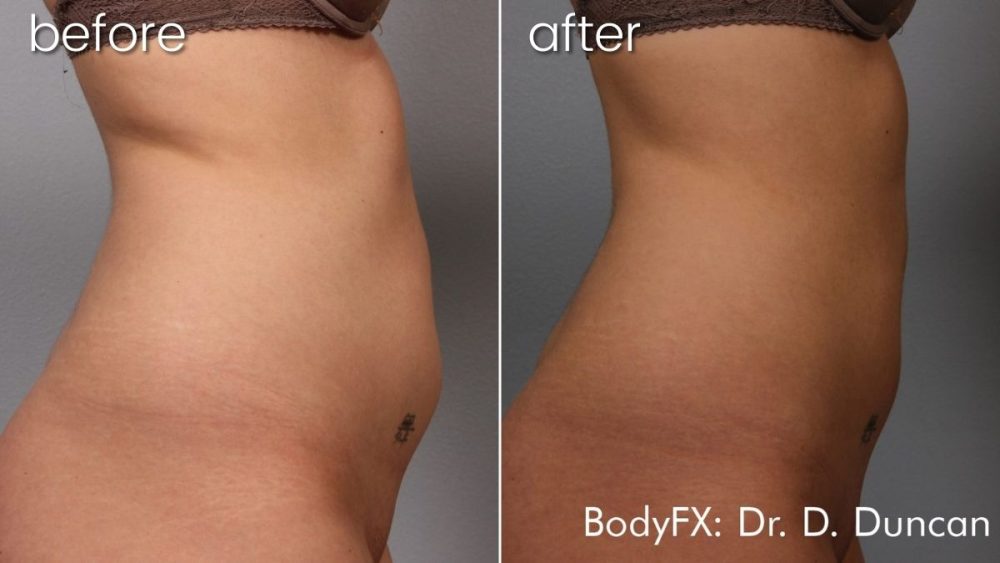 Before and after abdomen weight loss comparison
