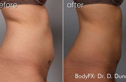 Before and after abdomen weight loss comparison