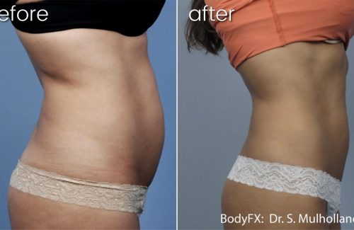 a before and after photo of a woman 's stomach showing the results of BodyFX to the abdomen