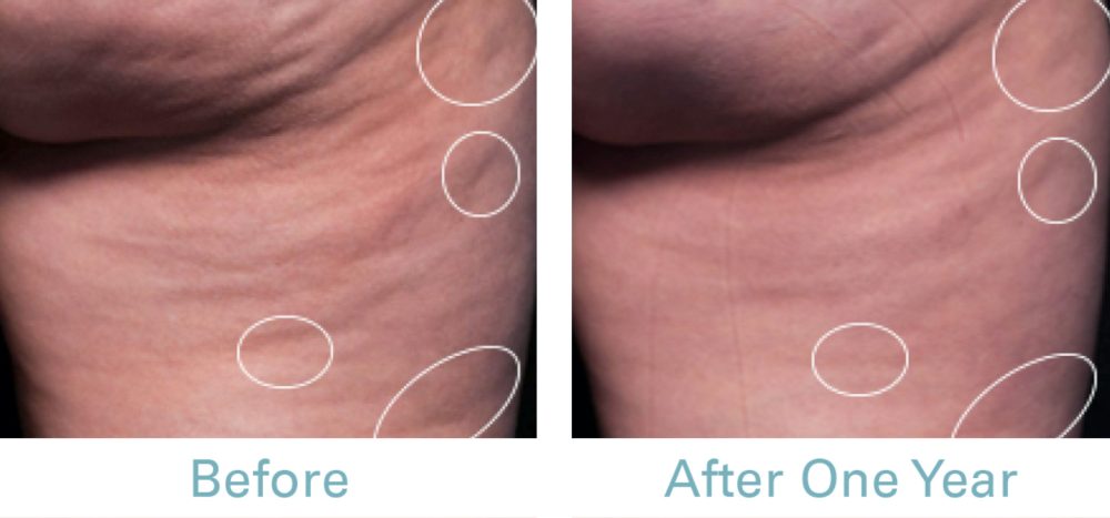 Before & After Cellulite Removal Treatment | Cellulite Treatment - Bakersfield CA