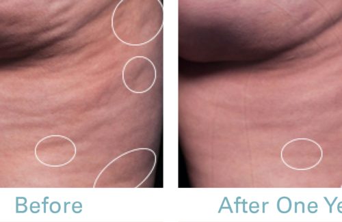 Before & After Cellulite Removal Treatment | Cellulite Treatment - Bakersfield CA