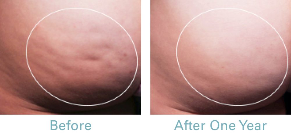 Cellulite Treatment Before & After Photo | Cellifina - Bakersfield CA