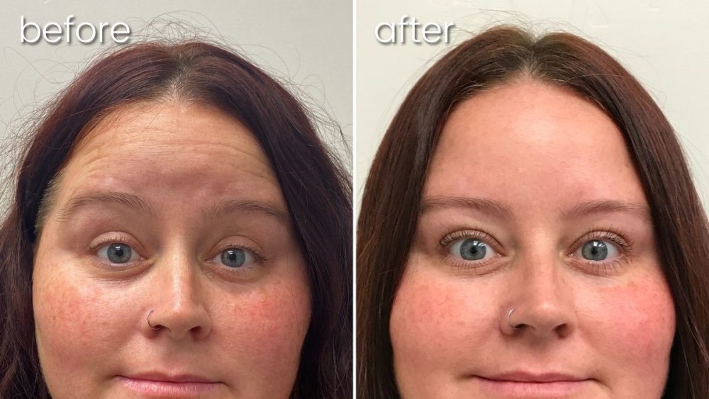 Before & After Neurotoxin on Woman's Forehead | Neurotoxin Skin Treatment - Bakersfield CA