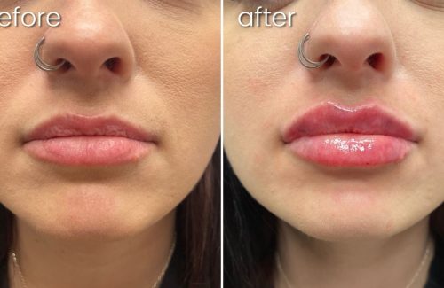 Before and after comparison of lip filler