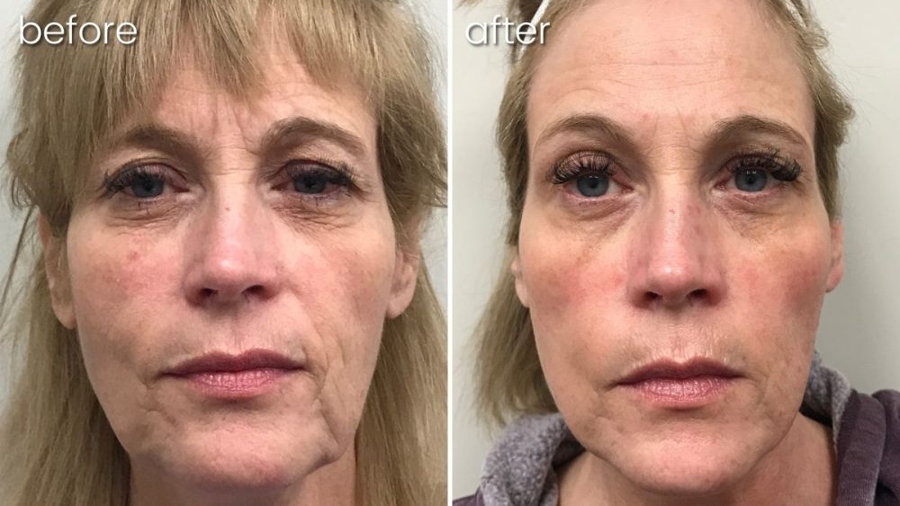 Before and After Morpheus 8 Treatment on Woman | Anti-Aging Treatment - Bakersfield CA