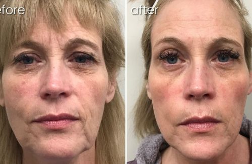 Before and After Morpheus 8 Treatment on Woman | Anti-Aging Treatment - Bakersfield CA