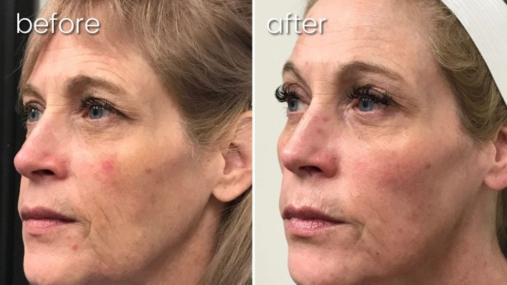 Before & After Morpheus 8 Treatment on Woman | Anti-Aging Treatment - Bakersfield CA