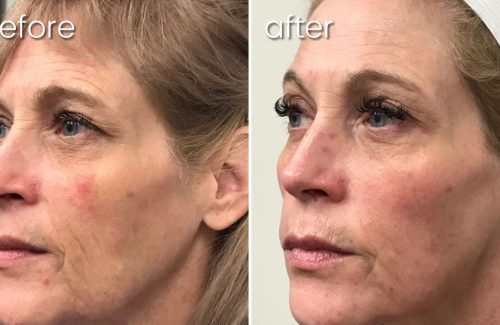 Before & After Morpheus 8 Treatment on Woman | Anti-Aging Treatment - Bakersfield CA