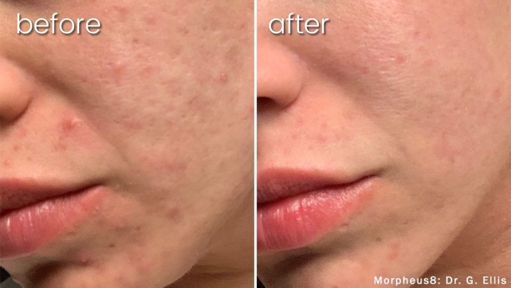 Before and after comparison of morpheus acne scar treatment